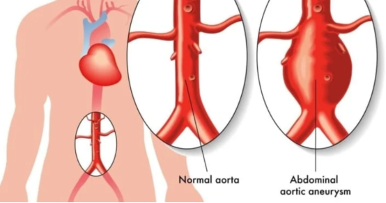Minimally invasive surgical treatment of abdominal aortic aneurysm
