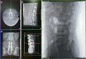 Spinal surgery solution—Digital Intraoperative Mobile 3D C-arm System Radiography Machine