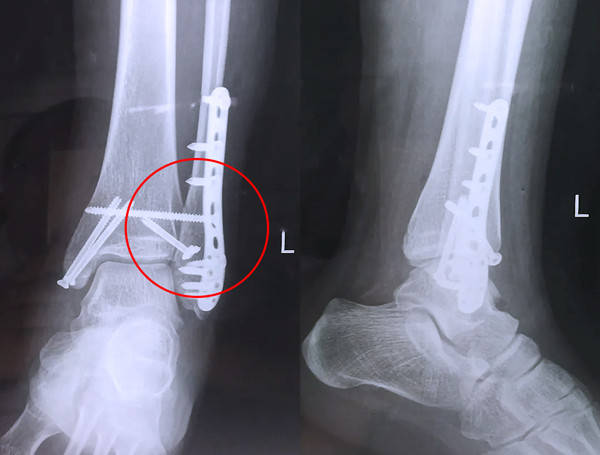 Medical Science] X-ray manifestations of ankle fractures - Nanjing Perlove  Medical Equipment Co., LTD