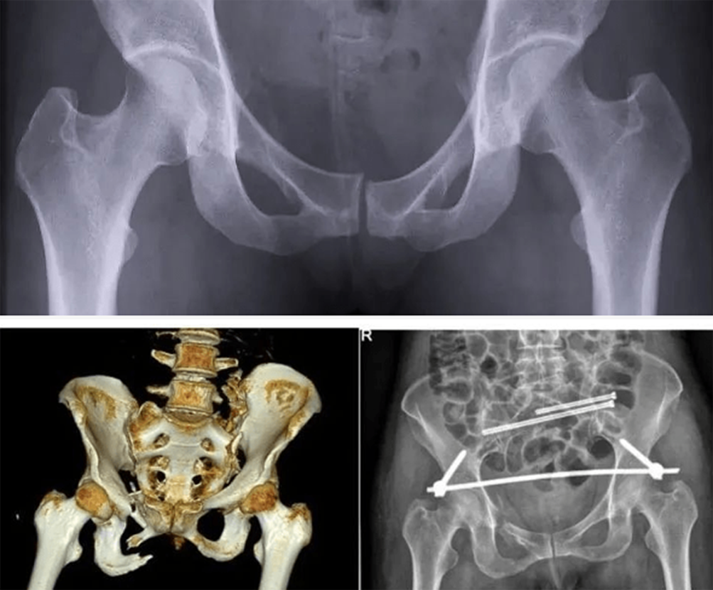 Main types of pelvic fractures