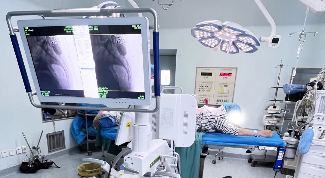 [Case sharing] Application of Perlove Medical's large flat-panel integrated C-arm in sacral neuromodulation