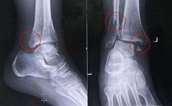 [Medical Science] X-ray manifestations of ankle fractures