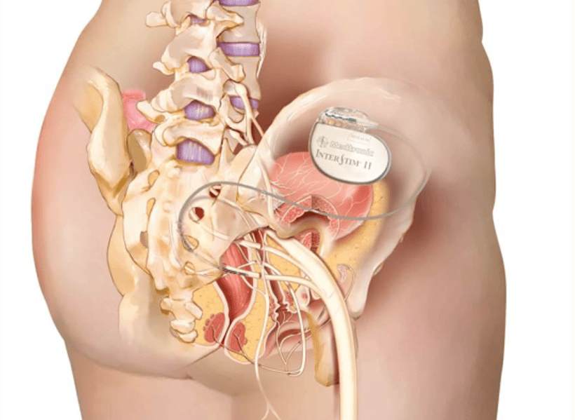 Surgical coordination of sacral neuromodulation under the guidance of large-plate integrated mobile C-arm