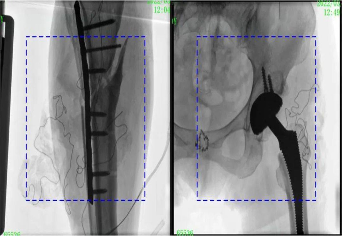 What are the advantages of the large size FPD C-arm? Display of large FPD images